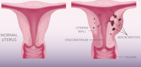 Adenomyosis image