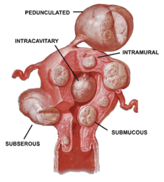Myomas image